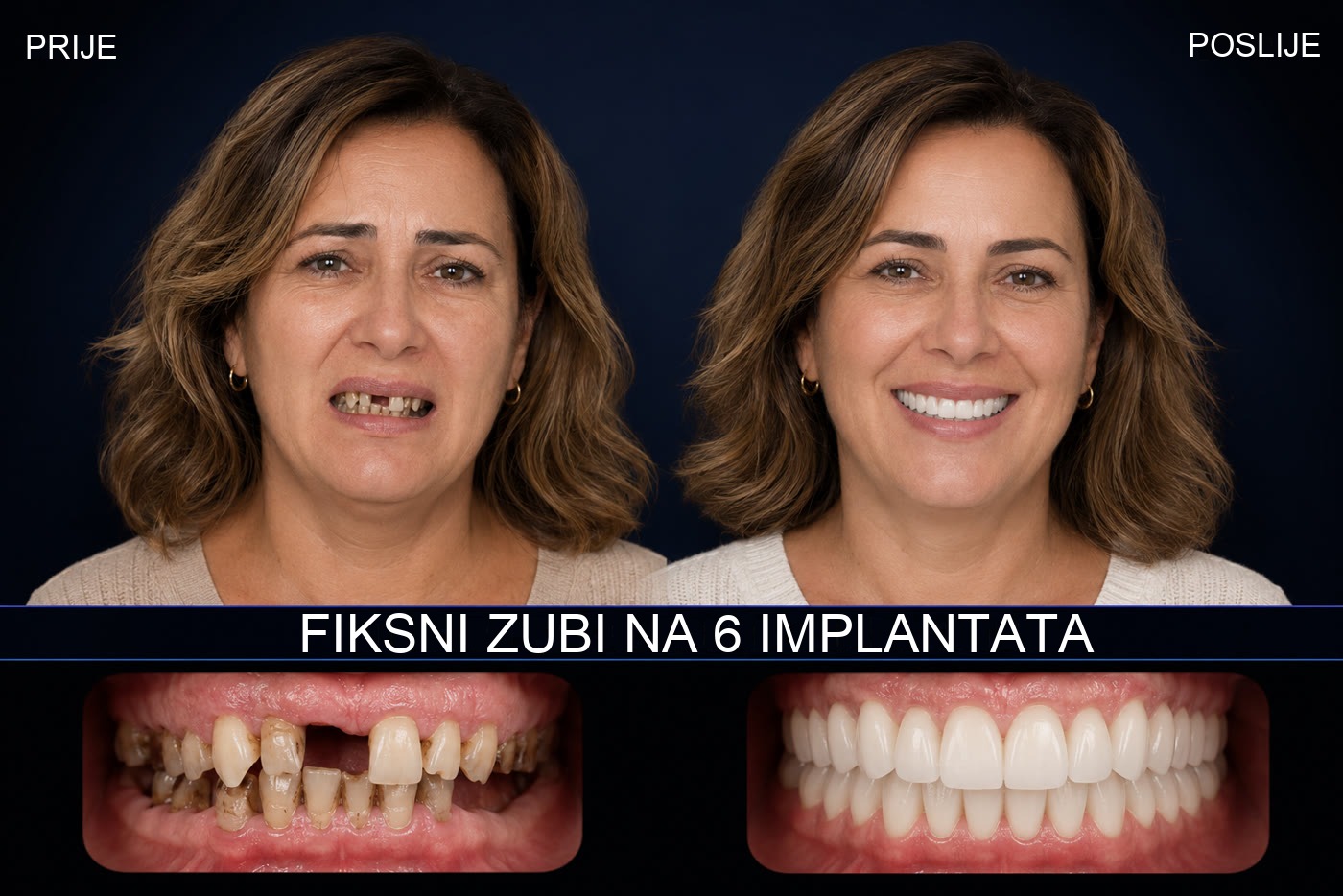 Prije i poslije — fiksni zubi na 6 implantata