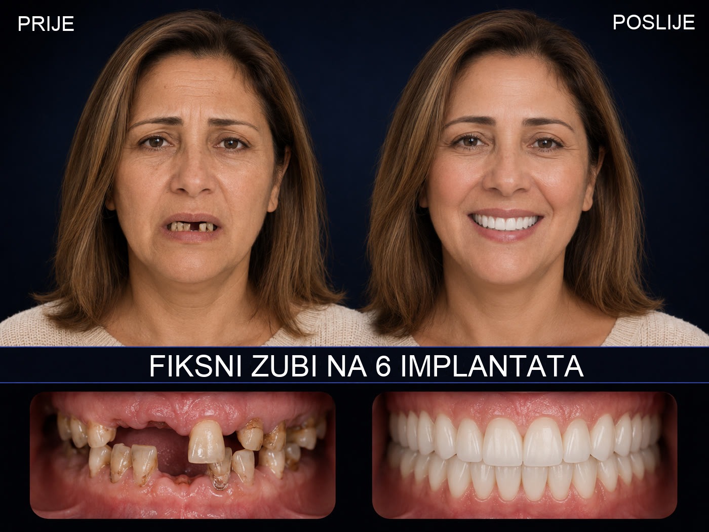 Prije i poslije — fiksni zubi na 6 implantata